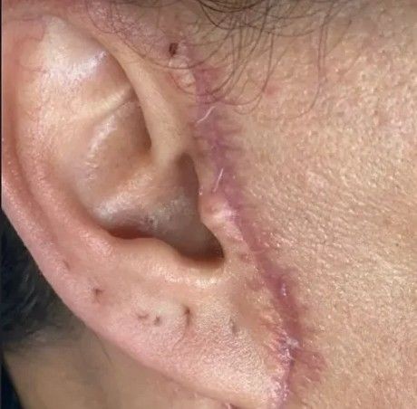 Nişantaşı'da estetik yaptıran kadın kabusu yaşadı! Kulağını kesip... - Resim: 5