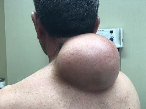 Boynundaki kocaman şişlikten çıkanlar mide bulandırdı! 'Doktor Çıban' bile gözlerine inanamadı - Resim: 1
