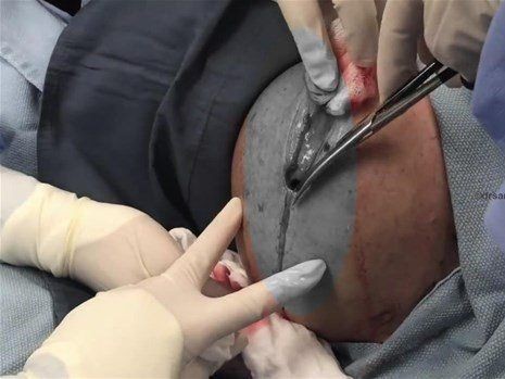Boynundaki kocaman şişlikten çıkanlar mide bulandırdı! 'Doktor Çıban' bile gözlerine inanamadı - Resim: 8
