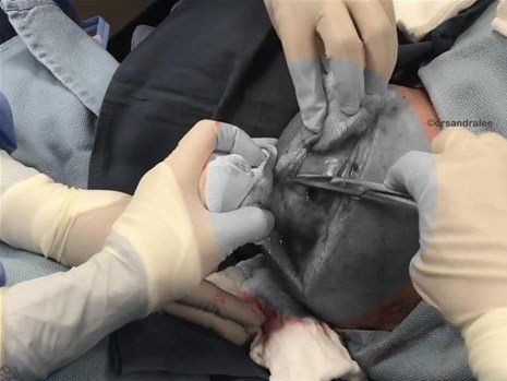 Boynundaki kocaman şişlikten çıkanlar mide bulandırdı! 'Doktor Çıban' bile gözlerine inanamadı - Resim: 9