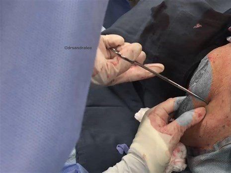 Boynundaki kocaman şişlikten çıkanlar mide bulandırdı! 'Doktor Çıban' bile gözlerine inanamadı - Resim: 25