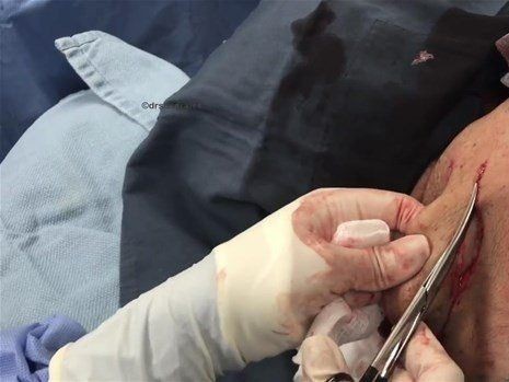 Boynundaki kocaman şişlikten çıkanlar mide bulandırdı! 'Doktor Çıban' bile gözlerine inanamadı - Resim: 29