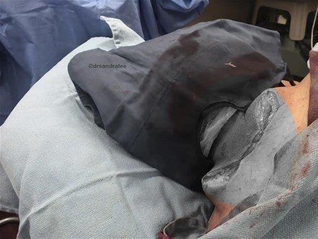 Boynundaki kocaman şişlikten çıkanlar mide bulandırdı! 'Doktor Çıban' bile gözlerine inanamadı - Resim: 35