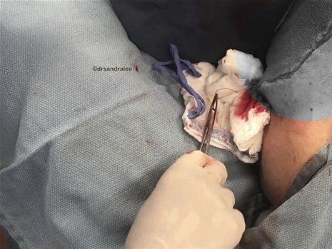 Boynundaki kocaman şişlikten çıkanlar mide bulandırdı! 'Doktor Çıban' bile gözlerine inanamadı - Resim: 38
