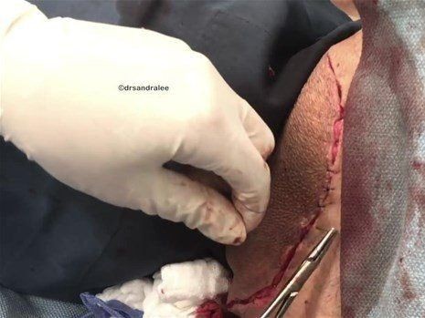 Boynundaki kocaman şişlikten çıkanlar mide bulandırdı! 'Doktor Çıban' bile gözlerine inanamadı - Resim: 39