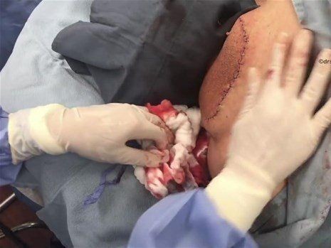 Boynundaki kocaman şişlikten çıkanlar mide bulandırdı! 'Doktor Çıban' bile gözlerine inanamadı - Resim: 40