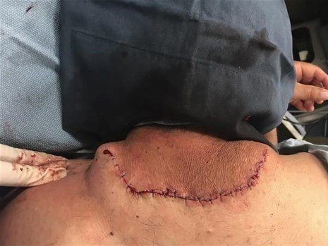 Boynundaki kocaman şişlikten çıkanlar mide bulandırdı! 'Doktor Çıban' bile gözlerine inanamadı - Resim: 41