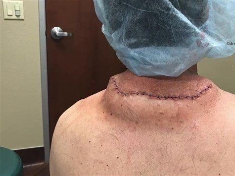 Boynundaki kocaman şişlikten çıkanlar mide bulandırdı! 'Doktor Çıban' bile gözlerine inanamadı - Resim: 43
