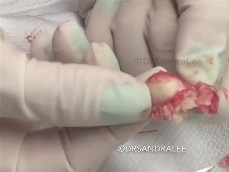 Boynundaki kocaman şişlikten çıkanlar mide bulandırdı! 'Doktor Çıban' bile gözlerine inanamadı - Resim: 47