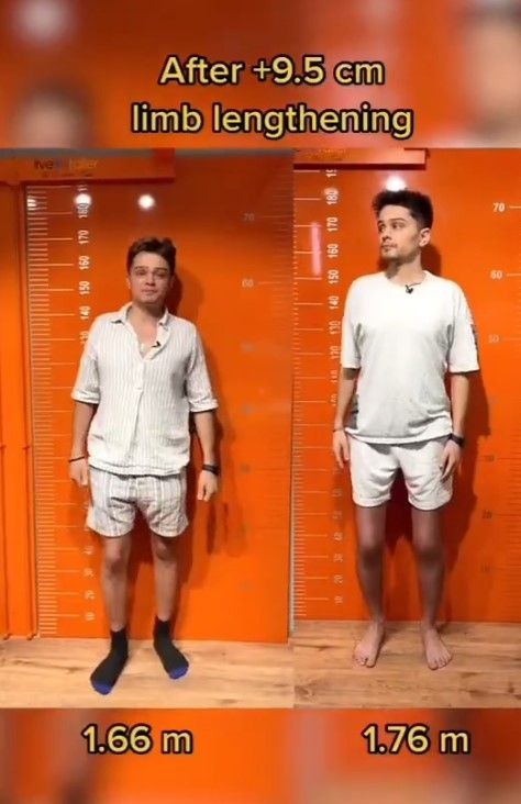 TikTok hayat karartmaya devam ediyor! Boyu uzadı mutluluğunu kaybetti! Boy uzatma akımına katılan fenomenin hayatı kabusa döndü - Resim: 6