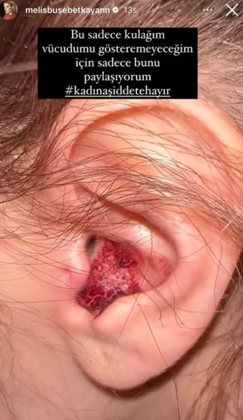 Kısmetse Olur yarışmasıyla tanınan Melis Buse Betkayan evli sevgilisinden gördüğü şiddeti duyurdu! - Resim: 4