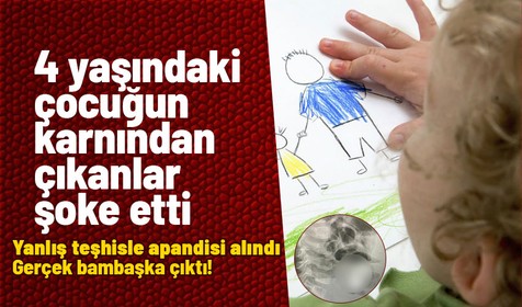 4 yaşındaki çocuğun karnından çıkanlar herkesi şoke etti! Yanlış teşhisle apandisti alındı gerçek bambaşka çıktı!