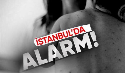 İstanbul'da korkutan tablo! Kızamık vakalarında artış görüldü