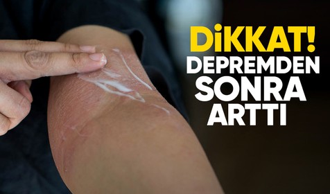 'Asrın felaketi' olarak nitelendirilen Kahramanmaraş depreminin ardından egzama şikayetleri arttı