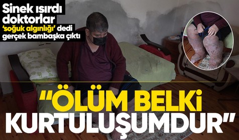 Denizli'den Antalya'ya çalışmak için giden güvenlik görelisi Kadir Karaoğlanoğlu sivrisinek ısırması sonucu fil ayağı hastalığına yakalandı