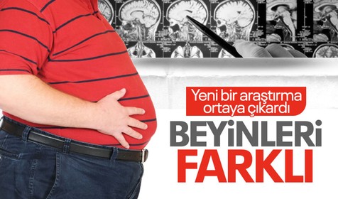 Bilim insanları açıkladı: Obeziteli bireylerin beyin şekli farklı