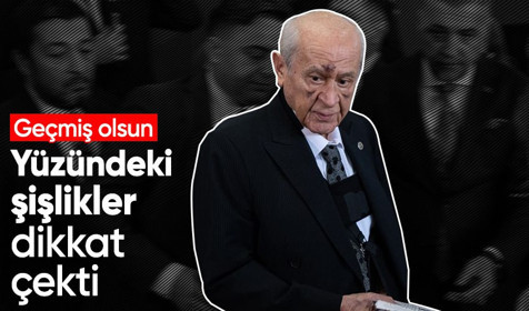 Son Dakika: Oyunu kullanan MHP Lideri Devlet Bahçeli'nin yüzündeki morluklar dikkat çekti! Peki sebebi ne?