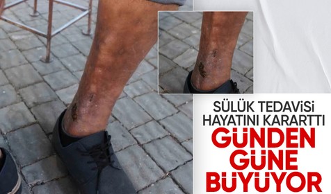 Sülük tedavisi Kayseri'de kuaför olan Mehmet Uğuş'un hayatını kararttı!