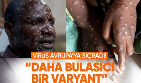 İsveç duyurdu! Maymun çiçeği virüsünün Avrupa'daki ilk vakası
