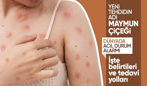 Maymun çiçeği virüsü dünyayı alarma geçirdi! Monkeypox nasıl bulaşır, belirtileri neler?