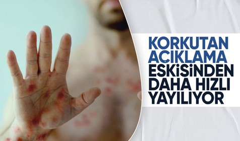 DSÖ'den korkutan 'maymun çiçeği' uyarısı: Eskisinden daha hızlı yayılıyor