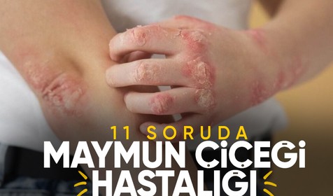 Sağlık Bakanlığı açıkladı: İşte 11 soruda 'Maymun Çiçeği' hastalığı