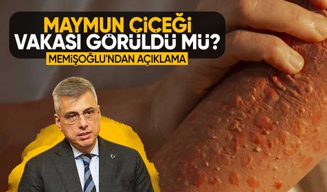 Son dakika! Sağlık Bakanı Kemal Memişoğlu'ndan maymun çiçeği açıklaması: Ülkemizde görülmedi, tedbire gerek yok