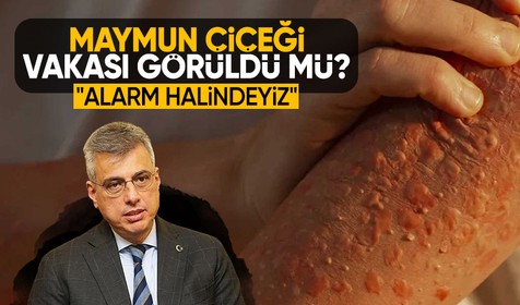 Kemal Memişoğlu: Şu ana kadar Maymun Çiçeği tanısı konulmuş bir hastamız yok