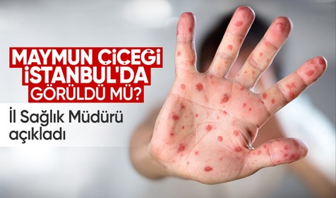 Maymun çiçeği İstanbul'da görüldü mü? İl Sağlık Müdürü açıkladı