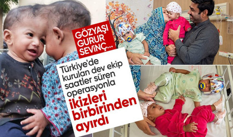 Pakistanlı yapışık ikizler Türkiye'de 14 saatlik operasyonla ayrıldı