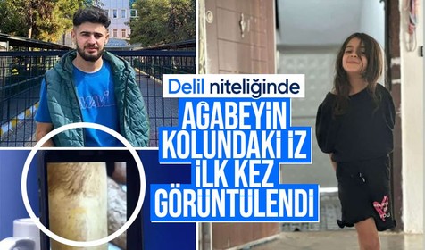 Narin Güran cinayetinde yeni delil: Ağabey Enes Güran’ın kolundaki ısırık izi görüntülendi
