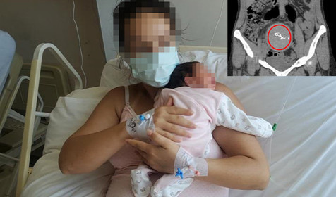 2 yıl sonra ortaya çıktı: Doğumda unutulan cisme soruşturma