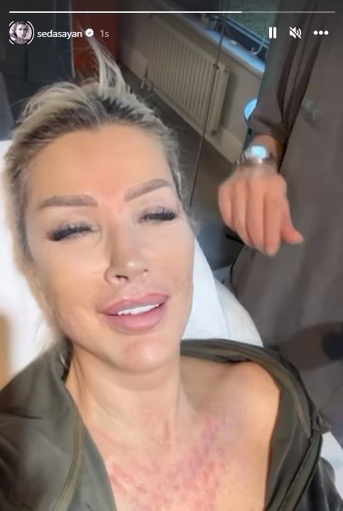 'Ben çorap kadınıyım' sözleriyle damga vuran Seda Sayan son dönemin popüler sünnet derisi operasyonunu yaptırdı! - Resim: 13
