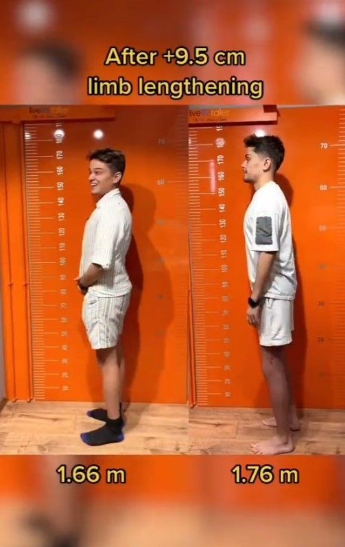 TikTok hayat karartmaya devam ediyor! Boyu uzadı mutluluğunu kaybetti! Boy uzatma akımına katılan fenomenin hayatı kabusa döndü - Resim: 4