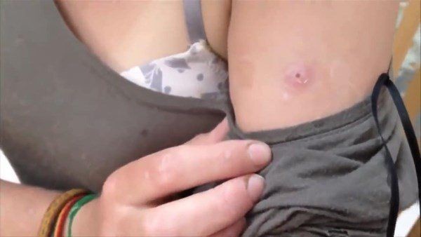 Sivilce zannettiği yaradan bakın ne çıktı! Kolundaki ağrı sonrası doktora gitti gözlerine inanamadı - Resim: 1