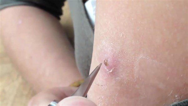 Sivilce zannettiği yaradan bakın ne çıktı! Kolundaki ağrı sonrası doktora gitti gözlerine inanamadı - Resim: 2