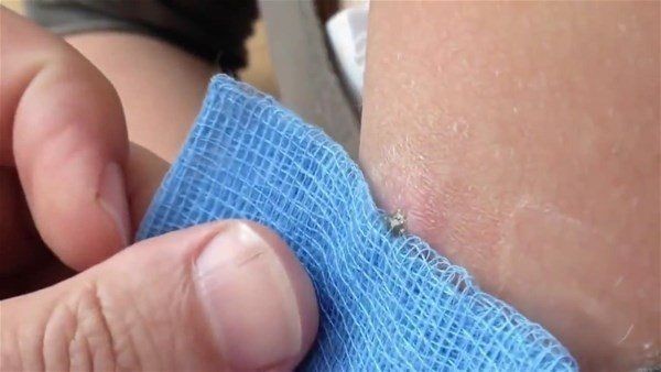 Sivilce zannettiği yaradan bakın ne çıktı! Kolundaki ağrı sonrası doktora gitti gözlerine inanamadı - Resim: 3