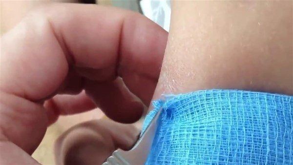 Sivilce zannettiği yaradan bakın ne çıktı! Kolundaki ağrı sonrası doktora gitti gözlerine inanamadı - Resim: 5