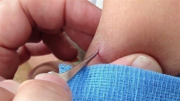 Sivilce zannettiği yaradan bakın ne çıktı! Kolundaki ağrı sonrası doktora gitti gözlerine inanamadı - Resim: 6
