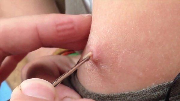 Sivilce zannettiği yaradan bakın ne çıktı! Kolundaki ağrı sonrası doktora gitti gözlerine inanamadı - Resim: 8