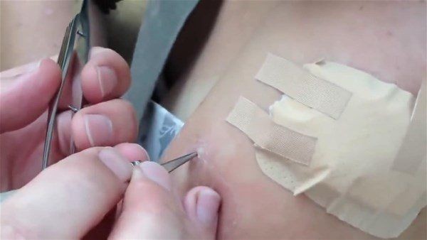 Sivilce zannettiği yaradan bakın ne çıktı! Kolundaki ağrı sonrası doktora gitti gözlerine inanamadı - Resim: 12
