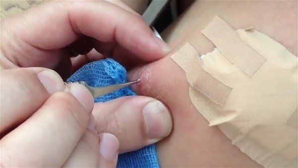 Sivilce zannettiği yaradan bakın ne çıktı! Kolundaki ağrı sonrası doktora gitti gözlerine inanamadı - Resim: 13