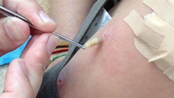 Sivilce zannettiği yaradan bakın ne çıktı! Kolundaki ağrı sonrası doktora gitti gözlerine inanamadı - Resim: 16