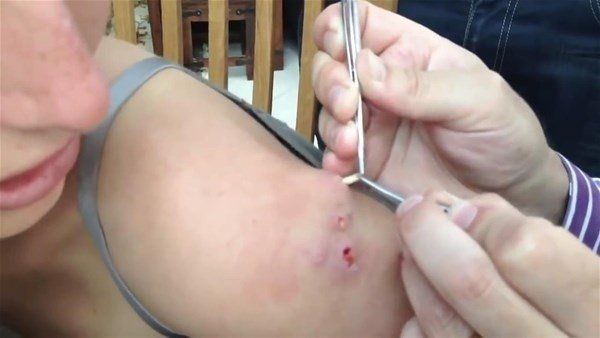 Sivilce zannettiği yaradan bakın ne çıktı! Kolundaki ağrı sonrası doktora gitti gözlerine inanamadı - Resim: 21