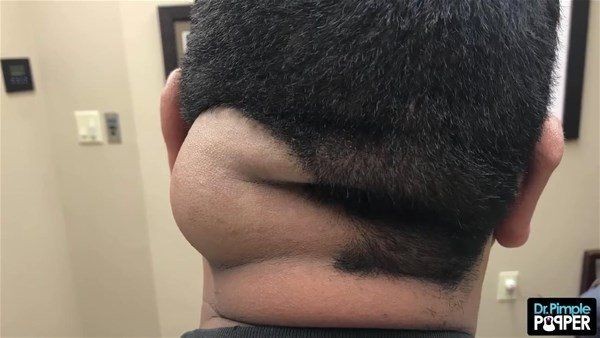 Görenlerin midesi bulanıyor! Ensesindeki kocaman şişlikten çıkanlar şaşırtıyor - Resim: 3