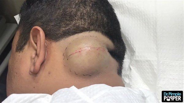 Görenlerin midesi bulanıyor! Ensesindeki kocaman şişlikten çıkanlar şaşırtıyor - Resim: 4