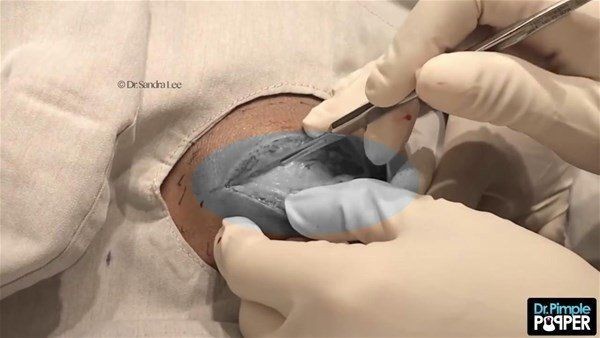 Görenlerin midesi bulanıyor! Ensesindeki kocaman şişlikten çıkanlar şaşırtıyor - Resim: 7