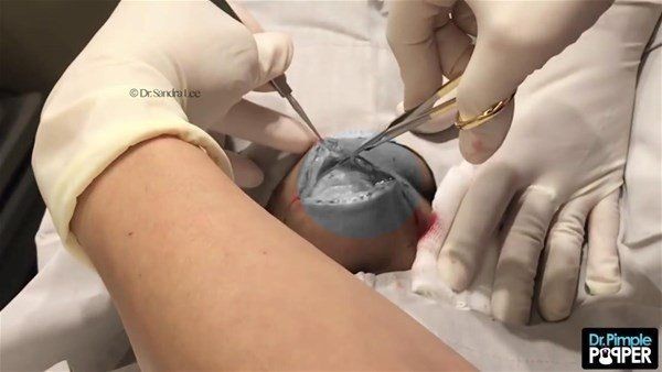 Görenlerin midesi bulanıyor! Ensesindeki kocaman şişlikten çıkanlar şaşırtıyor - Resim: 8