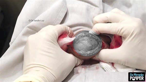 Görenlerin midesi bulanıyor! Ensesindeki kocaman şişlikten çıkanlar şaşırtıyor - Resim: 10