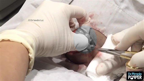 Görenlerin midesi bulanıyor! Ensesindeki kocaman şişlikten çıkanlar şaşırtıyor - Resim: 11